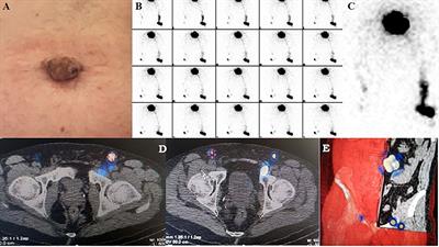 SPECT/CT-Guided Surgical Removal of a Positive External Iliac Sentinel Node in Primary Umbilical Melanoma: Report of a Case, and Up-to-Date Review of the Literature